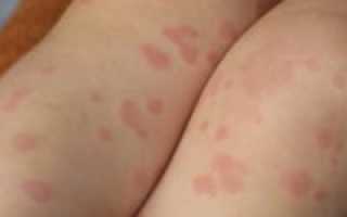 Причины появления красных пятен на ногах и ступнях