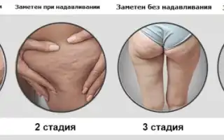 Причины развития целлюлита