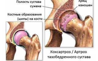 Коксартроз тазобедренного сустава — лечение и профилактика