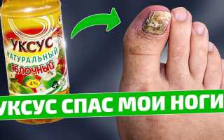 Как избавиться от грибка на ногтях с помощью уксуса?