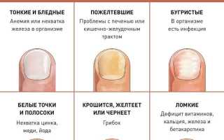 Стадии развития грибка ногтей на ногах и руках.