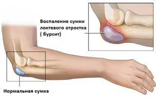 Бурсит локтевого сустава — виды, причины, симптомы и последствия