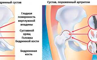 Симптомы и лечение артрита тазобедренного сустава