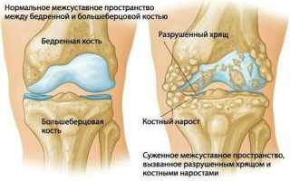 Деформирующий остеоартроз — формы и лечение