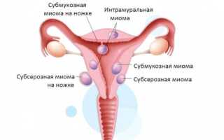 Чем опасна миома для жизни женщины?
