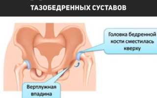 Дисплазия тазобедренного сустава у новорожденных — почему появляется и чем опасна