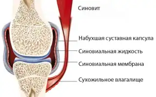 Синовит коленного сустава — лечение стандартными методами