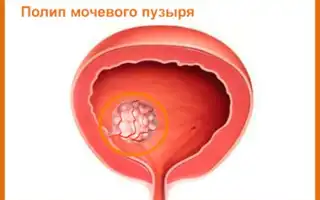 Папилломатоз мочевого пузыря — классификация разрастаний, причины, симптомы и лечение заболевания