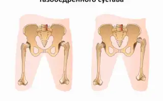 Дисплазия – это что