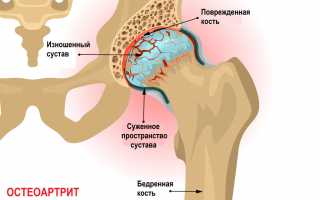Боль в тазобедренном суставе — виды боли и причины появления