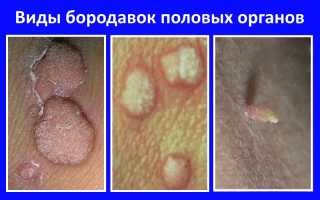 Папилломы на интимных местах: причины, симптомы, методы лечения, фото, опасность, риск инфицирования полового партнера