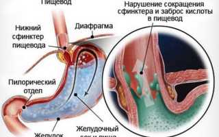 Эзофагит пищевода – есть ли риск заболеть и как с ним бороться?