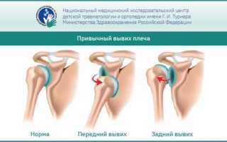 Вывих плечевого сустава — виды, симптомы, реабилитация