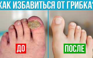 Можно ли избавиться от грибка ногтей быстро?