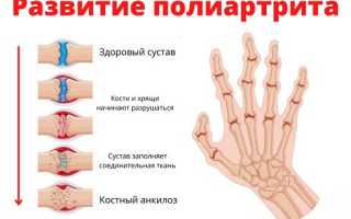 Полиартрит — разновидности и диагностика