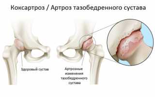 Коксартроз — лечение заболевания и прогноз на дальнейшую жизнь