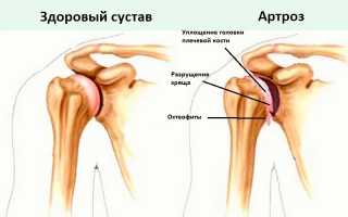 Симптомы артроза плечевого сустава и методы его лечения