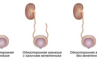 Агенезия почки – приговор?