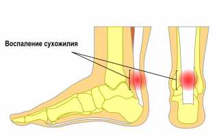 Тендинит — причины, симптомы, локализация