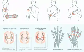 Симптомы артрита у детей и особенности его лечения