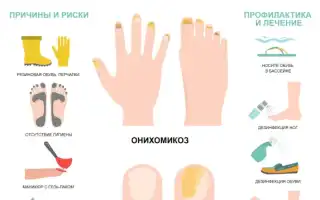 Где и как можно заразиться грибком ногтей и как уберечься от инфекции?