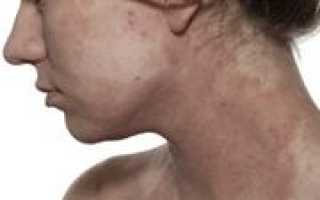 Причины происхождения экземы. От чего быват? Почему появляется?
