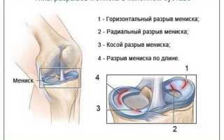 Повреждение мениска — его признаки, классификация и последствия