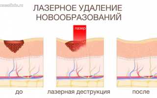 Лазерное удаление как наиболее эффективный современный метод деструкции папиллом
