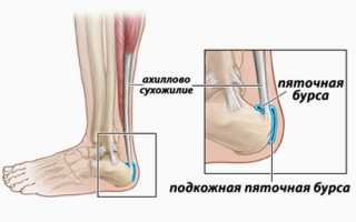 Ахиллобурсит — как распознать и чем лечить боль в пятке