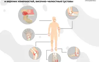 Реактивный артрит — что это за болезнь и каковы её особенности