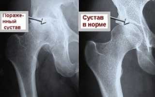 Артрит тазобедренного сустава — определение первостепенной причины