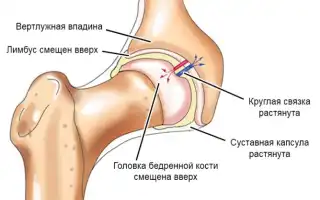 Дисплазия тазобедренных суставов — опасное врожденное заболевание