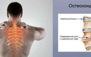 Как поможет мануальная терапия при шейном остеохондрозе