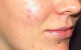 Последствия, которых стоит опасаться при удалении черных точек
