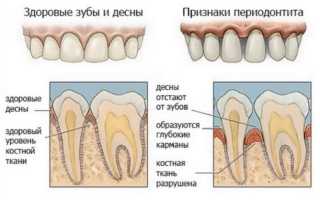 Лечение десен: причины, симптомы и народные методы лечения