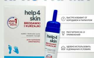Деструкция папиллом с помощью холода — аппаратный метод и домашнее удаление Криофарма