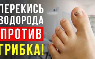 Лечение грибка ногтей перекисью водорода