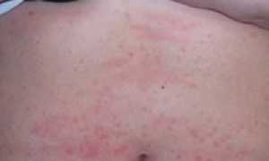Почему чешется живот и как устранить причины зуда