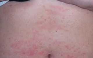 Почему чешется живот и как устранить причины зуда