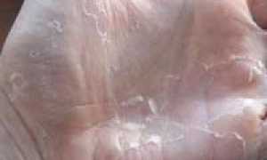 Облазит кожа на ладонях: о чем это говорит, и как бороться с проблемой?