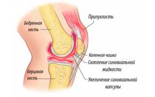 В коленном суставе жидкость — причины, симптомы, диагностика и лечение
