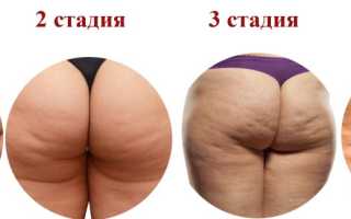 Я стесняюсь целлюлита: эффективные советы как замаскировать неровности на теле