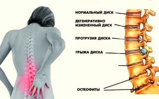Симптомы и лечение поясничного остеохондроза — чем опасно заболевание