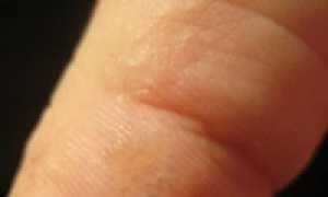 Водянистые прыщи на пальцах рук и ладонях: причины, методы лечения и профилактики