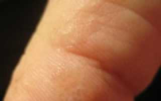 Водянистые прыщи на пальцах рук и ладонях: причины, методы лечения и профилактики