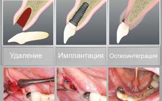 Одномоментная имплантация зубов
