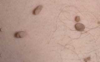 У кого могут появиться папилломы? Симптомы, признаки и лечение