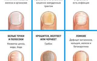 Способы лечения грибка ногтей и их описание