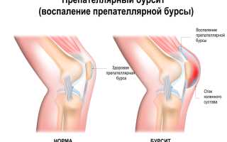 Боль в коленном суставе — симптомы, причины, диагностика