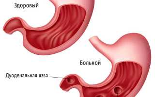 Что важно знать о язве луковицы двенадцатиперстной кишки?